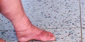 أخصائي تغذية علاجية يحذر من 4 أكلات تسبب تورم وثقل الساقين